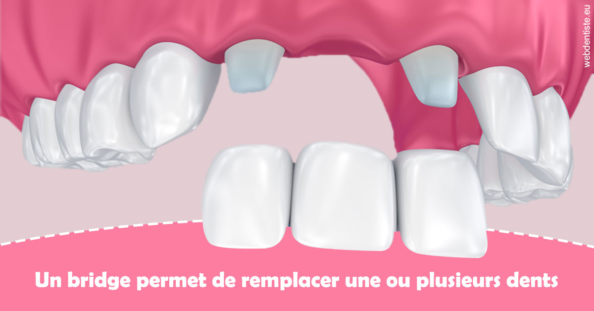 https://selarl-thierry-blanchot.chirurgiens-dentistes.fr/Bridge remplacer dents 2