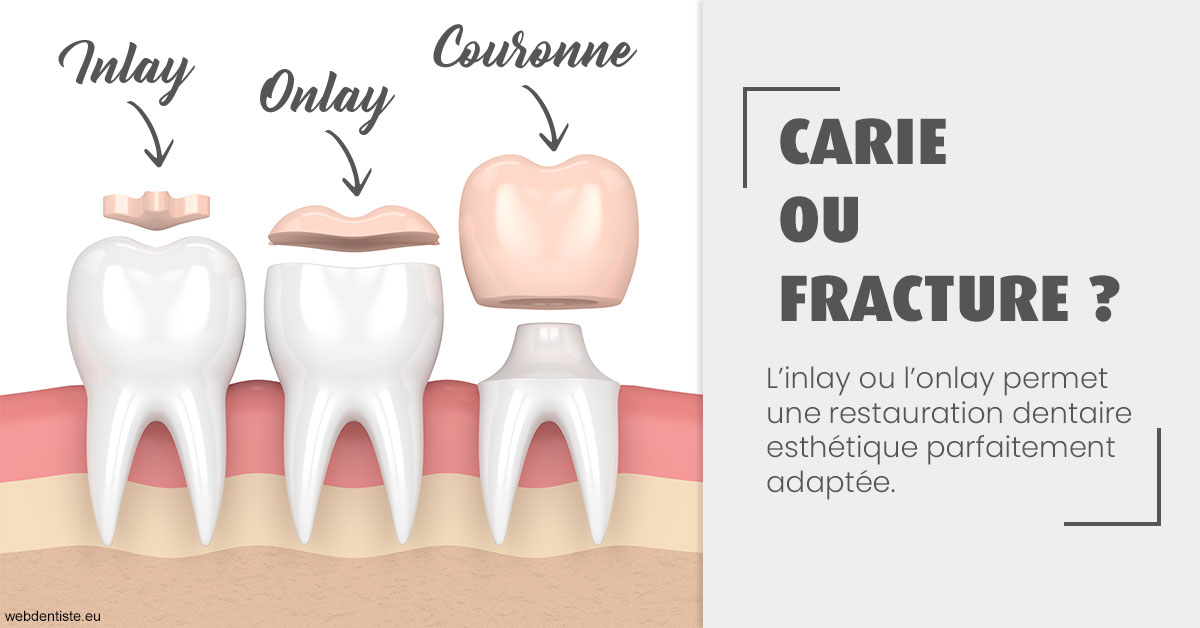 https://selarl-thierry-blanchot.chirurgiens-dentistes.fr/T2 2023 - Carie ou fracture 1