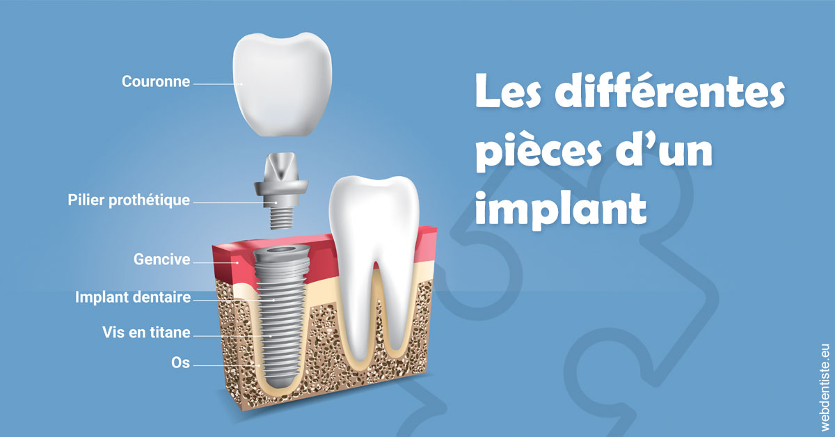 https://selarl-thierry-blanchot.chirurgiens-dentistes.fr/Les différentes pièces d’un implant 1